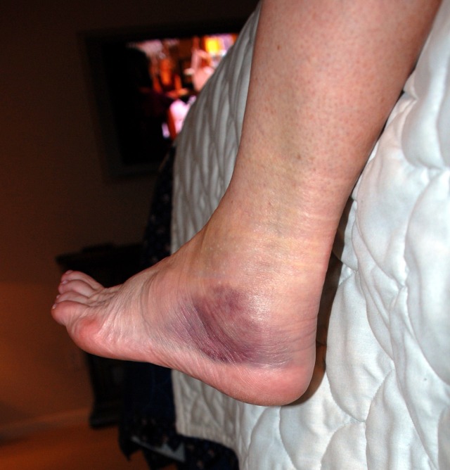 2009/02(Feb)/Sprained Ankle/2009-02-08-01 SPRAINED ANKLE.jpg